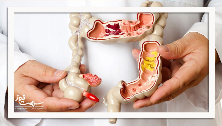 روده نشتپذیر چیست و چه تاثیری در سلامت دارد