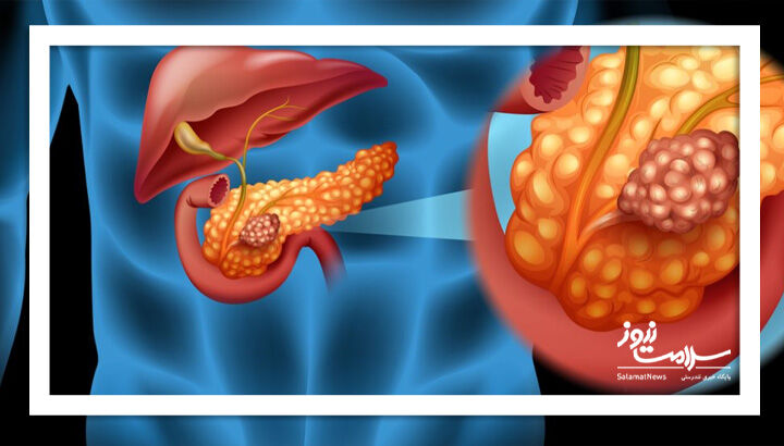 تایید اولین قرص مؤثر در افزایش طول عمر بیماران مبتلا به سرطان پیشرفته پانکراس