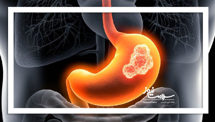 ارتباط مصرف نوشیدنیهای شیرین با افزایش خطر سرطان معده