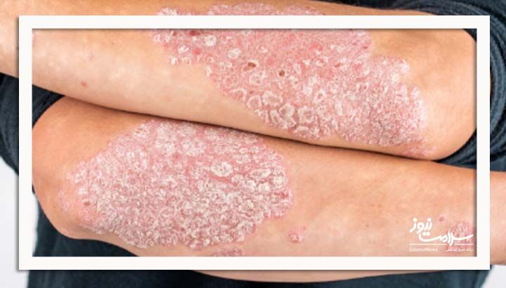 پسوریازیس بیماری فراتر از مشکلات پوستی و تأثیرات متعدد بر سلامت قلب، چشم، مفاصل و دستگاه گوارش