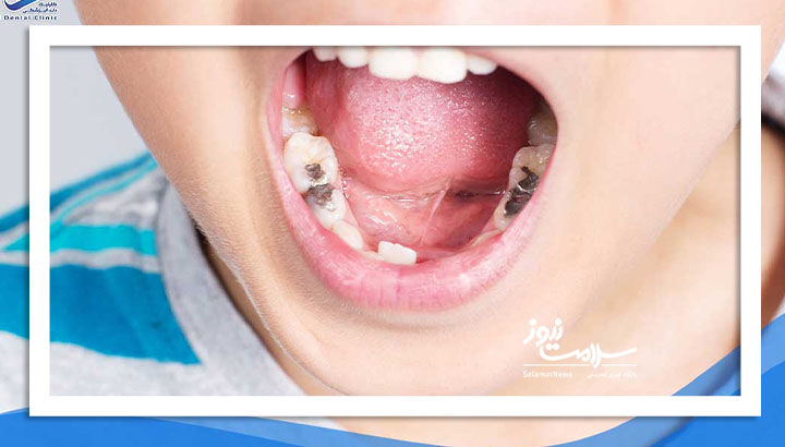 برنامههای وزارت بهداشت برای پیشگیری و مراقبت از پوسیدگی دندان کودکان