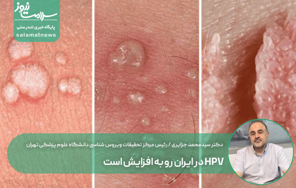 افزایش مبتلایان به HPV در ایران همزمان با کمبود آموزش و برنامه واکسیناسیون