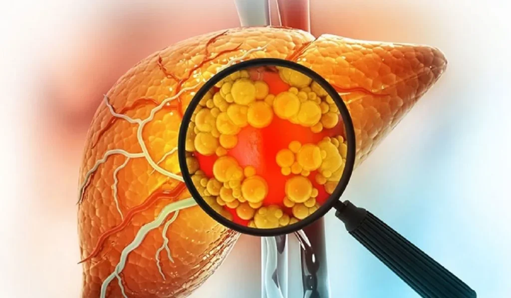 کبد چرب؛ کشف پنج زیرگروه متفاوت با خطرات خاص
